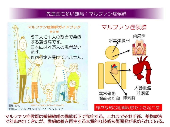 症候群 マル ファン